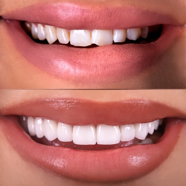 Before and Afters of smile makeovers