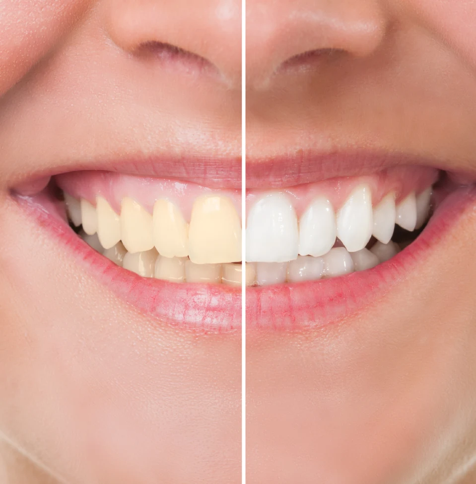 before and after teeth-whitening treatment