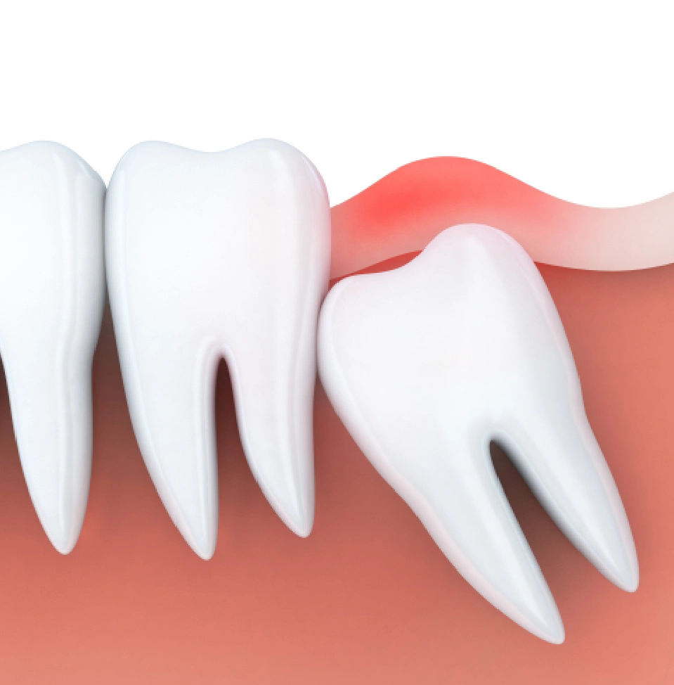what is wisdom tooth removal?