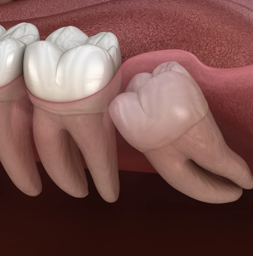 when should you contact our office after wisdom tooth removal